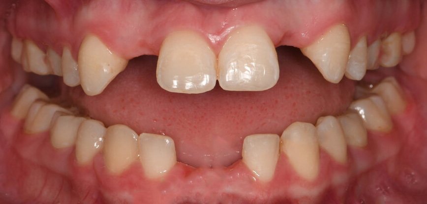 Denti colpiti da agenesia dentale